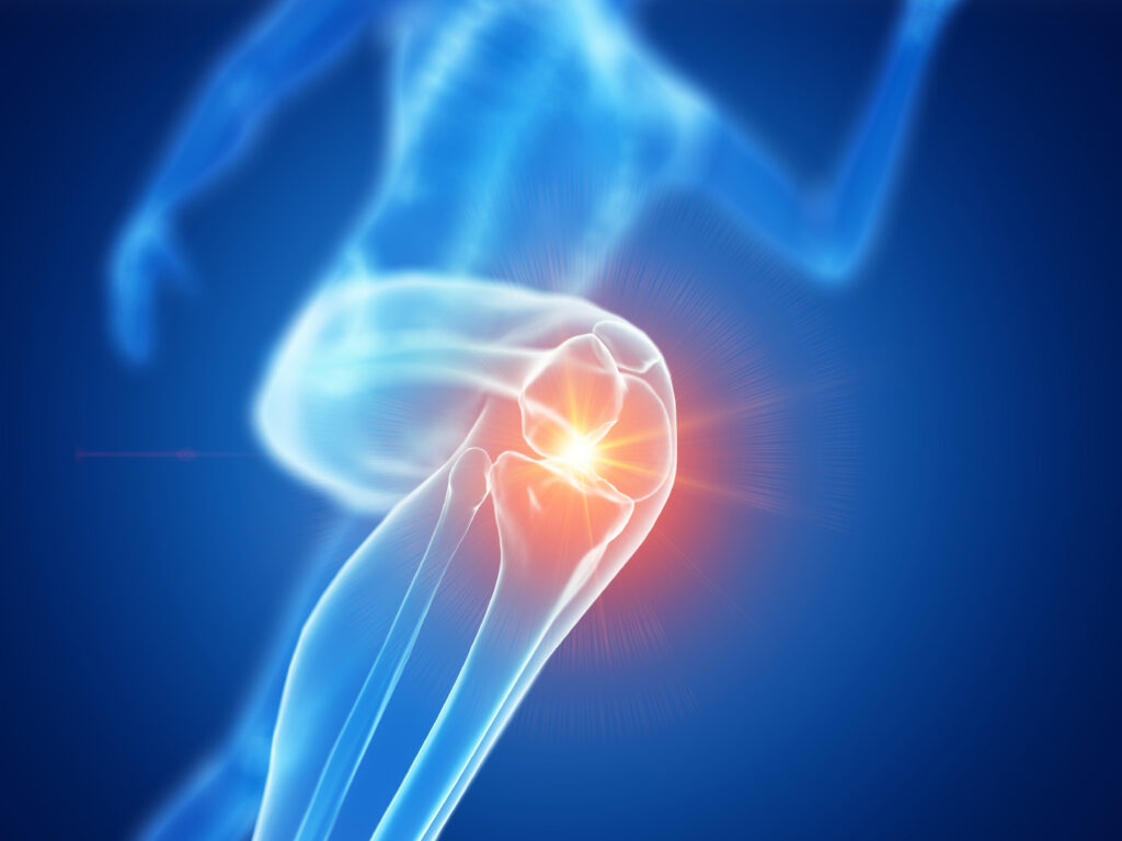 3d rendered illustration of a joggers painful knee